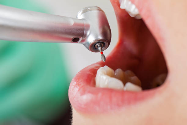 Best Knocked-Out Tooth (Avulsed Tooth) Treatment in Blackwells Mills, NJ